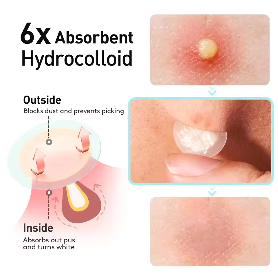 443pcs water-based gel acne pa - огляд і ціна Skincare You